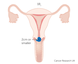 Cervical cancer stage 1B1