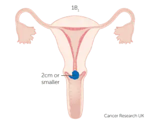 Cervical cancer stage 1B1