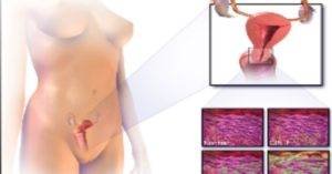 cervical cancer stages 1