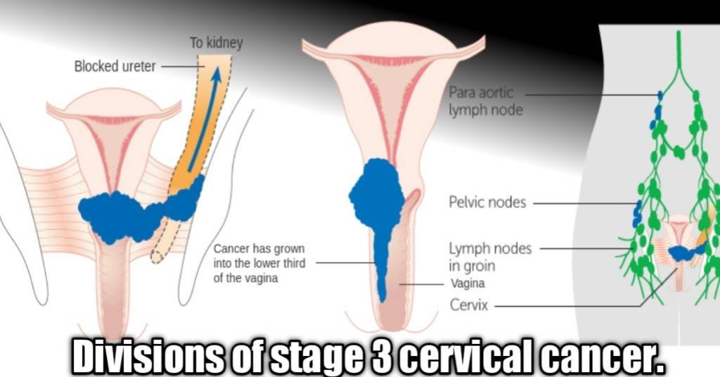 cervical cancer stages 3