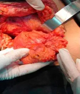 Reconstruction of breast after cancer. 3 Flap breast reconstruction