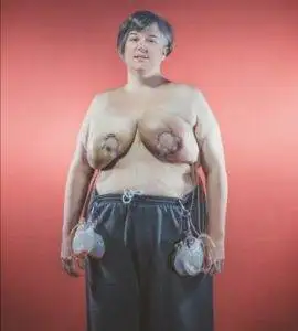 Reconstruction of breast after cancer. 5 Post breast reconstruction surgery with drains in situ..