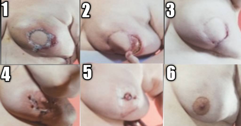 Stages of healing of a reconstructed breast
