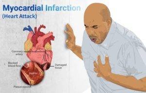 A man clutching his chest due to a heart attack