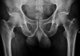An X-ray of an osteoporotic hip.