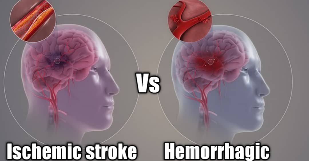 Ischemic stroke vs hemorrhagic