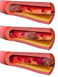 clogging of an artery.