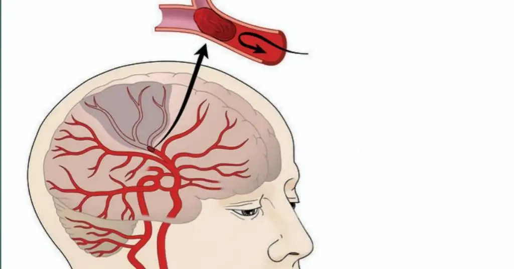 Treatment for transient ischemic attack. 1 Treatment for transient ischemic attack