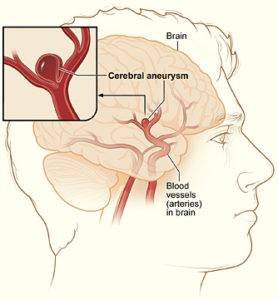 cerebral aneurysm