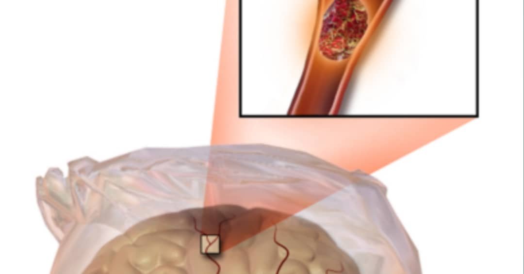 Life expectancy after a mini stroke