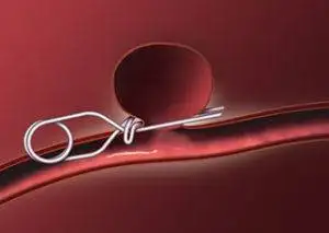 Treatments for hemorrhagic stroke. 4 Treatments for hemorrhagic stroke.