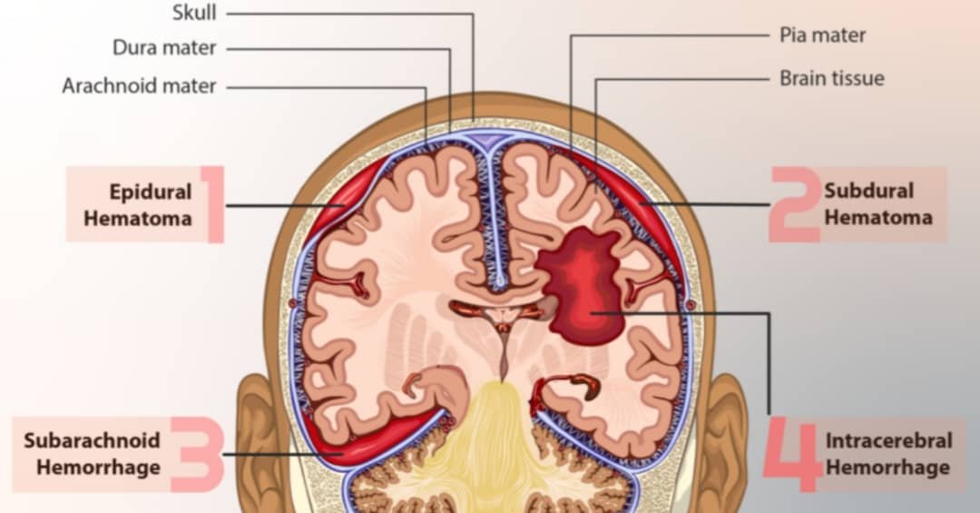 types of brain hemorrhage,