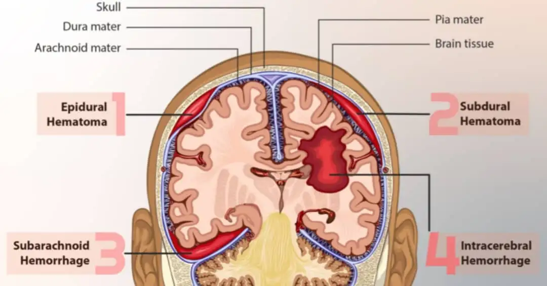 Treatments for hemorrhagic stroke. 1 types of brain hemorrhage,