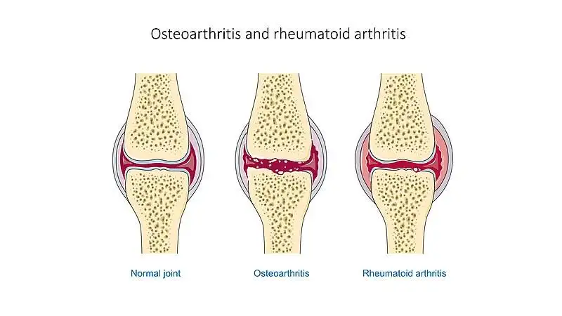 Osteoarthritis vs. Rheumatoid Arthritis. 2 Arthritis Osteo vs Rheumatoid.