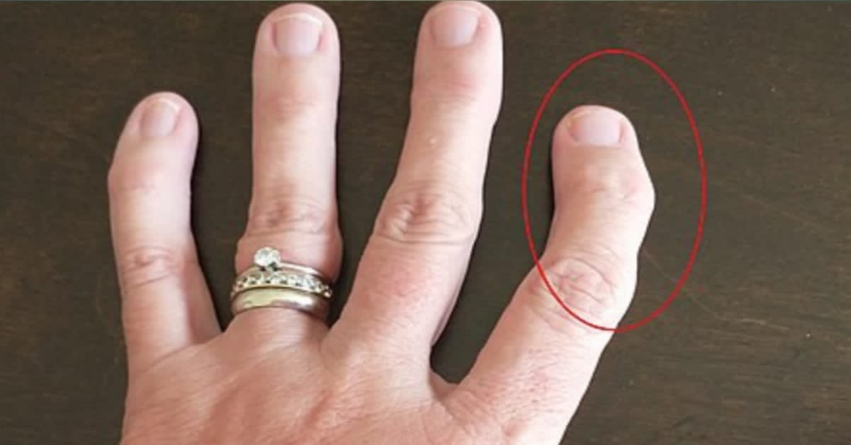 Arthritis of the fingers