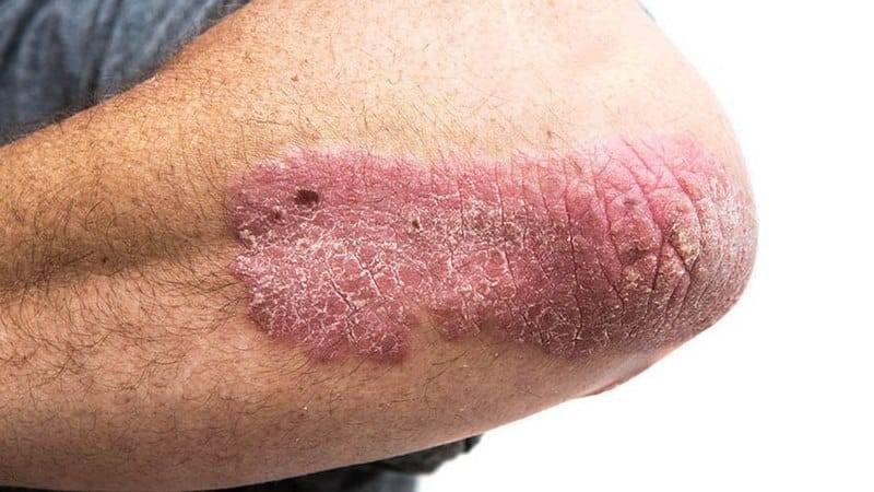 Psoriasis plaque extending from the elbow