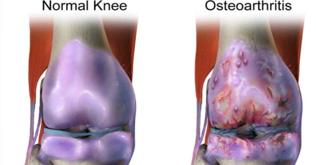 Treatment of arthritis in knees
