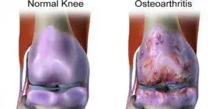 Treatment of arthritis in knees