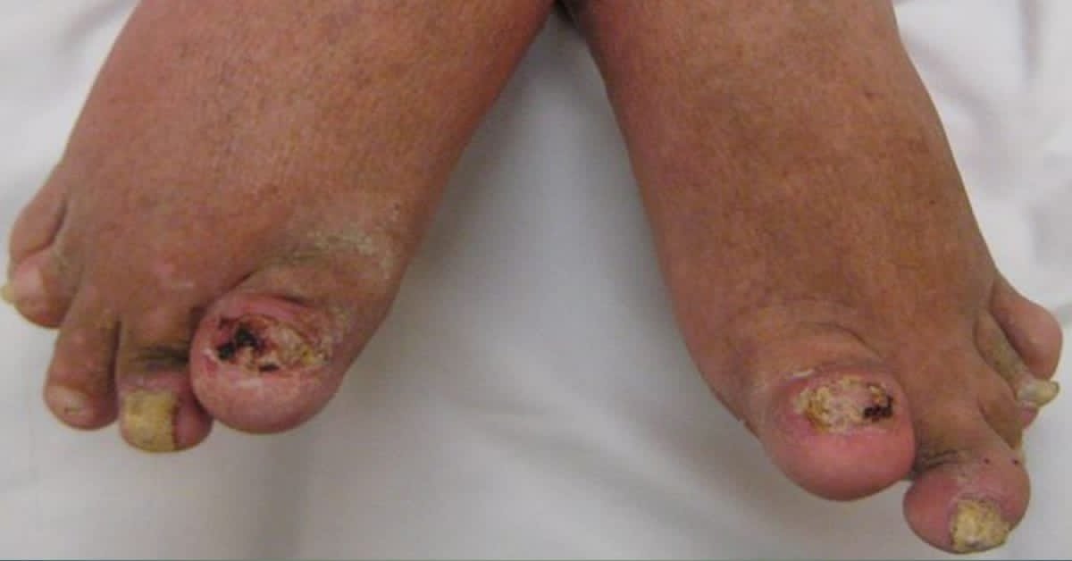 Treatment of psoriasis arthritis.
