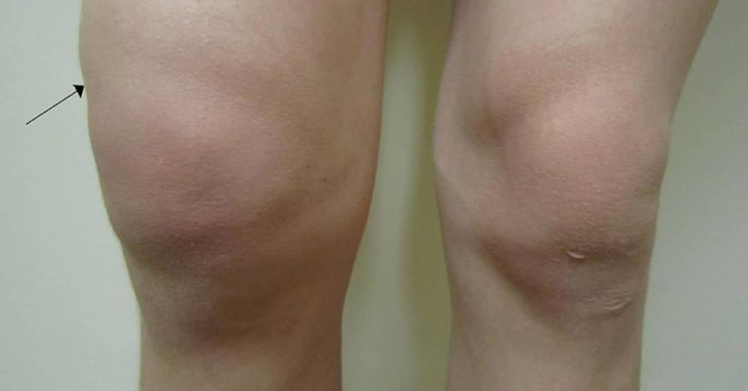 Swollen knee from arthritis
