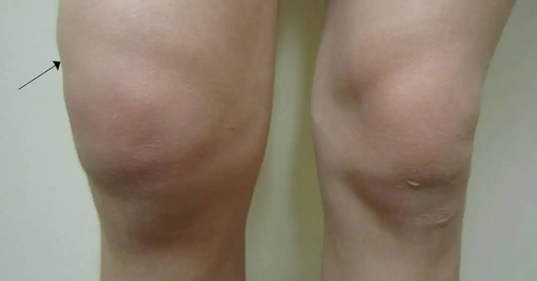 Swollen knee from arthritis