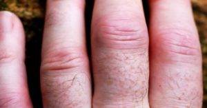 Rheumatoid arthritis early signs