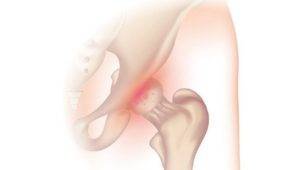 Exercises for arthritis of the hip.