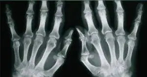 How is psoriasis arthritis diagnosed.