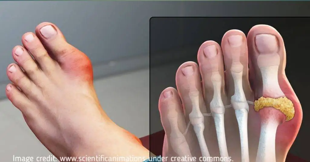 Gouty arthritis