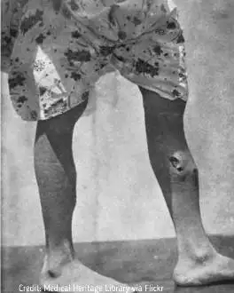 Osteomyelitis