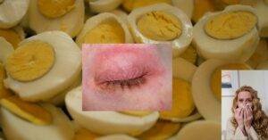 Image shows a swollen eyelid of someone allergic to egg protein, a woman sneezing from an allergy reaction and several boiled eggs cut in half.