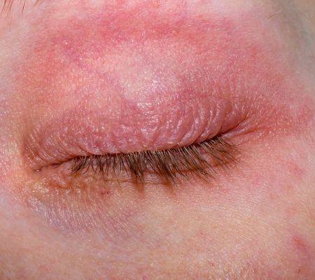 skin inflammation and swollen eyelid allergic reaction to egg protein.